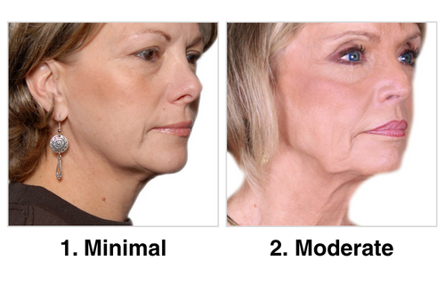 minimal and moderate aging examples minimal and moderate aging examples