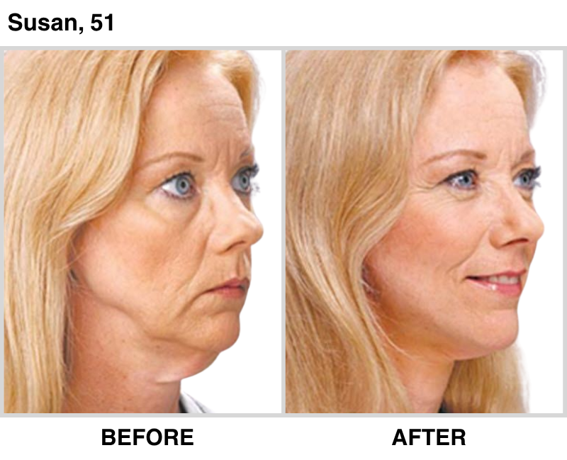BEFORE & AFTER - Lifetime Lift (800 x 649 px) (1)