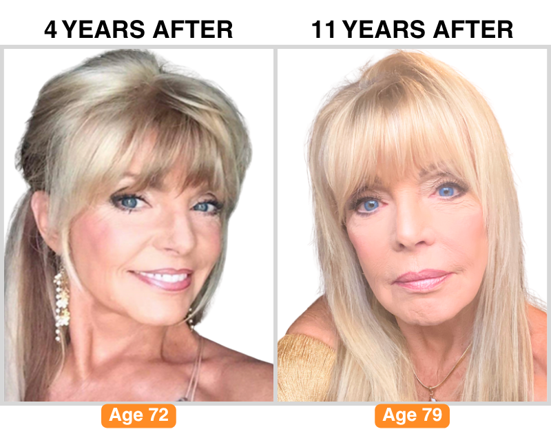 BEFORE & AFTER - Lifetime Lift (800 x 649 px) (4)